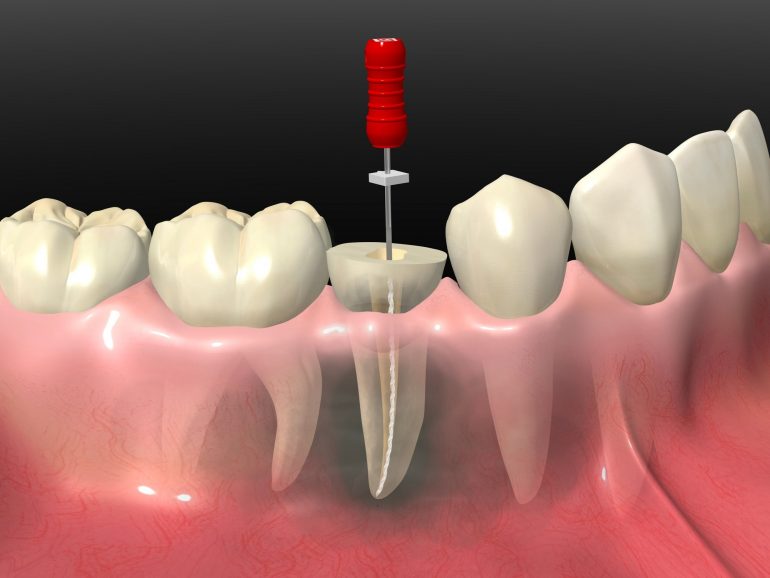 天然の歯を残す「根管治療」
