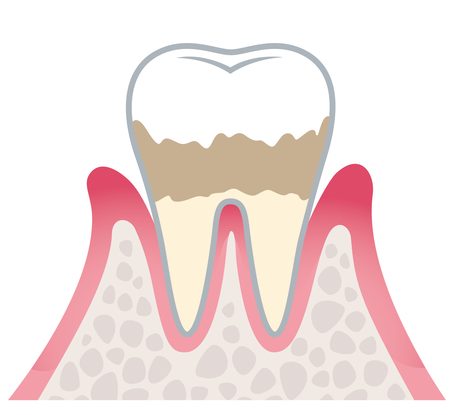 軽度歯周炎