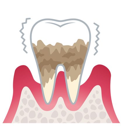 重度歯周炎