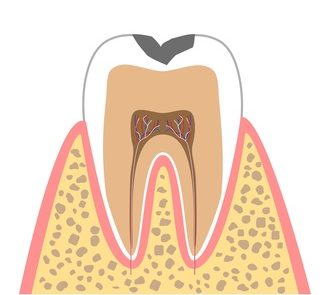 C1…エナメル質のむし歯