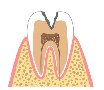 C2…象牙質のむし歯