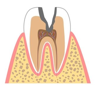 C3…歯髄に達したむし歯