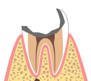 C4…歯根に達したむし歯